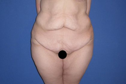 Extended Tummy Tuck Before & After Patient #3246