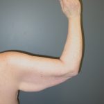 Arm Lift Before & After Patient #3970