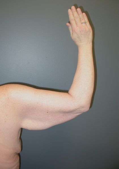 Arm Lift Before & After Patient #3970