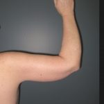 Arm Lift Before & After Patient #3970