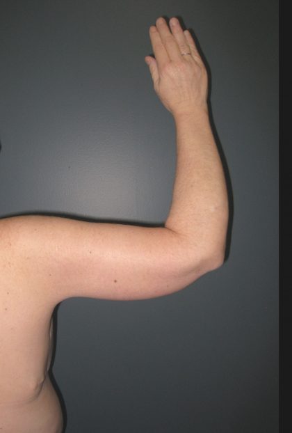 Arm Lift Before & After Patient #3970