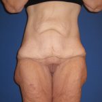 Extended Tummy Tuck Before & After Patient #3979