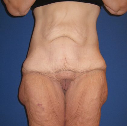 Extended Tummy Tuck Before & After Patient #3979