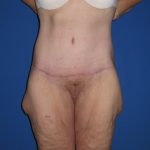 Extended Tummy Tuck Before & After Patient #3979