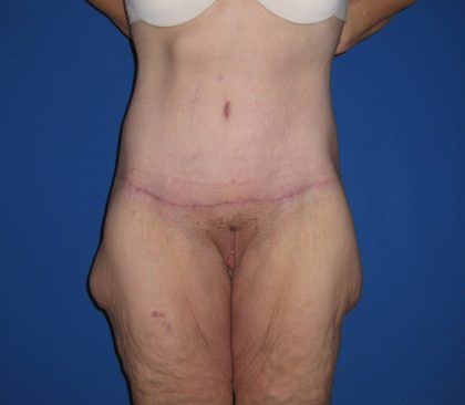 Extended Tummy Tuck Before & After Patient #3979