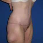 Extended Tummy Tuck Before & After Patient #3979