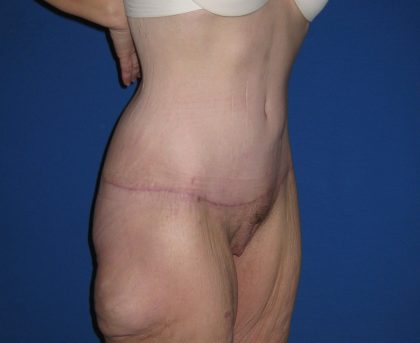 Extended Tummy Tuck Before & After Patient #3979