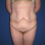 Extended Tummy Tuck Before & After Patient #4004