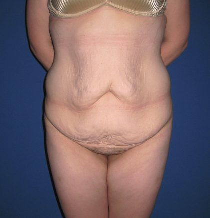 Extended Tummy Tuck Before & After Patient #4004