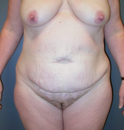 Extended Tummy Tuck Before & After Patient #4011