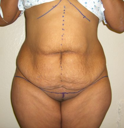 Extended Tummy Tuck Before & After Patient #4018