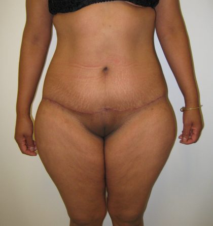 Extended Tummy Tuck Before & After Patient #4018