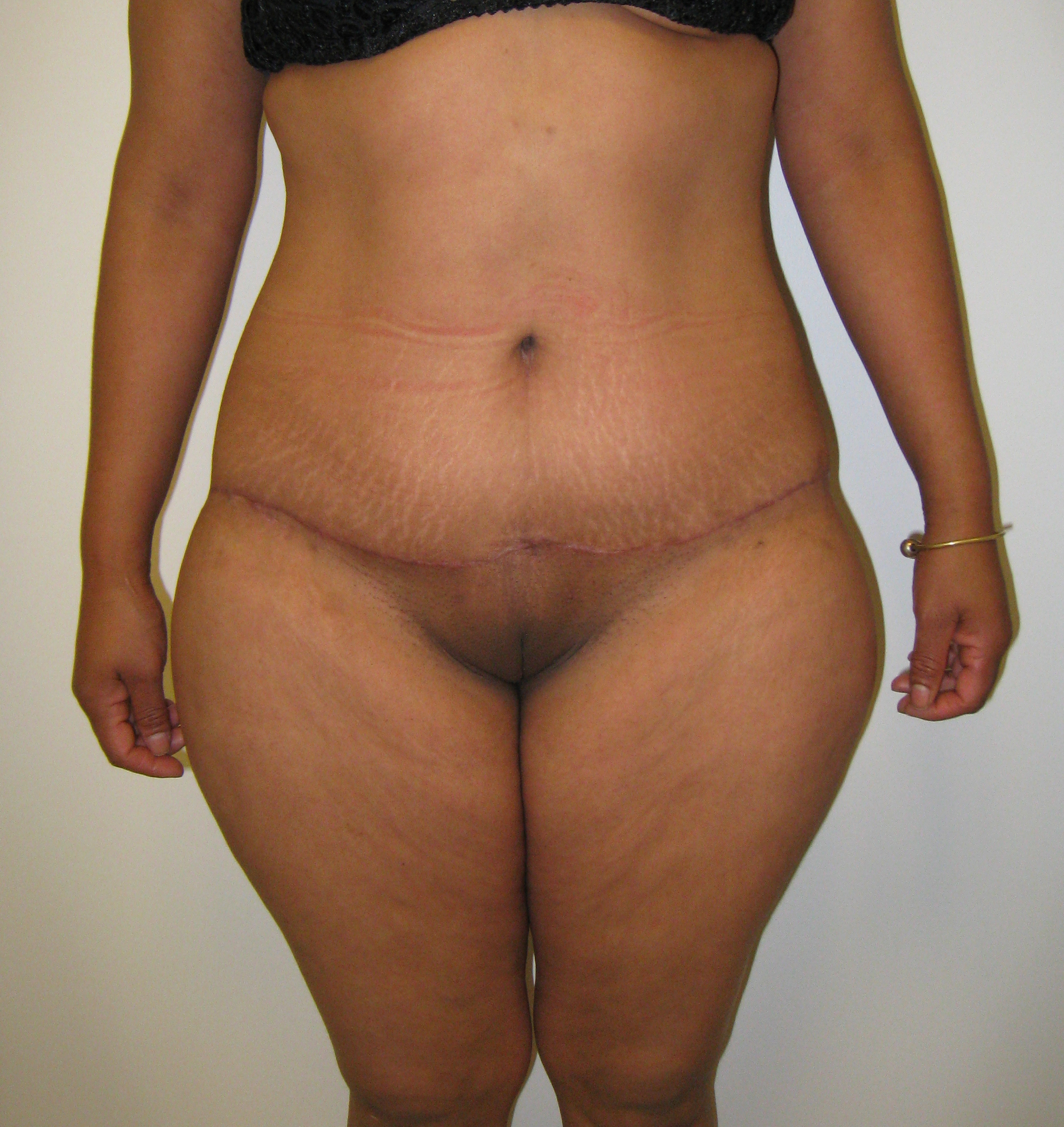 Extended Tummy Tuck Before & After Patient #4018