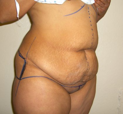 Extended Tummy Tuck Before & After Patient #4018