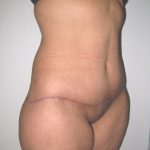 Extended Tummy Tuck Before & After Patient #4018