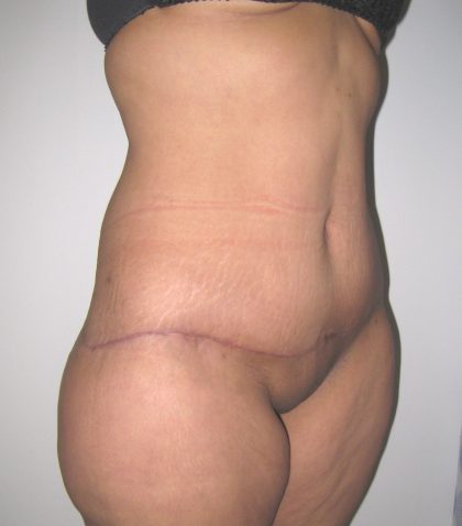 Extended Tummy Tuck Before & After Patient #4018