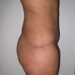 Extended Tummy Tuck Before & After Patient #4018