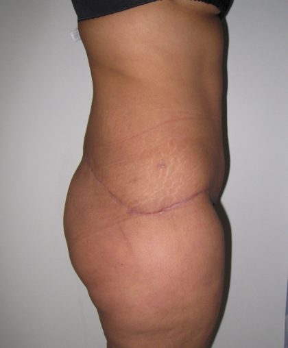 Extended Tummy Tuck Before & After Patient #4018