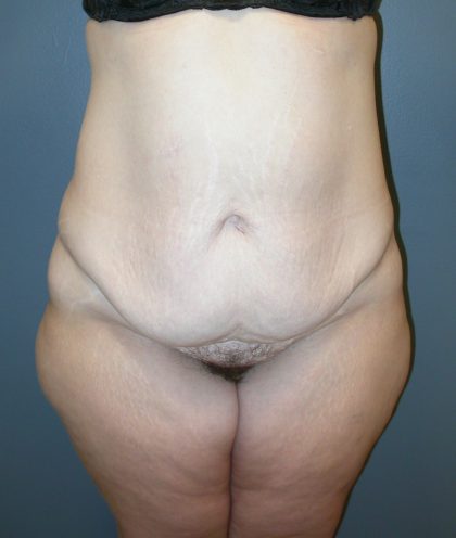 Extended Tummy Tuck Before & After Patient #4025