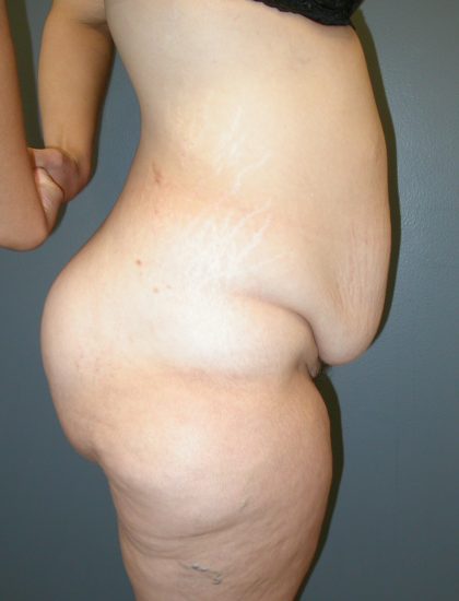 Extended Tummy Tuck Before & After Patient #4025