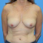 Breast Augmentation with Lift Before & After Patient #2966