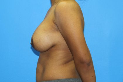 Breast Augmentation with Lift Before & After Patient #3062