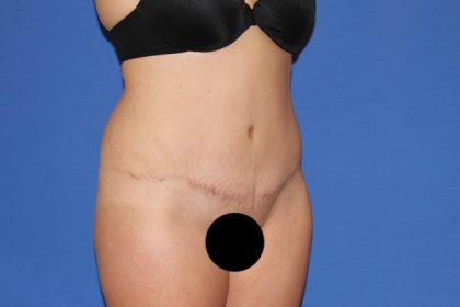 Tummy Tuck Before & After Patient #3331