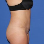 Tummy Tuck Before & After Patient #3331