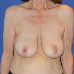 Breast Lift Before & After Patient #3479