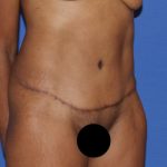 Tummy Tuck Before & After Patient #3345