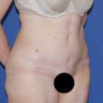 Tummy Tuck Before & After Patient #3352