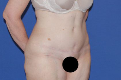 Tummy Tuck Before & After Patient #3352