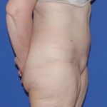 Tummy Tuck Before & After Patient #3352