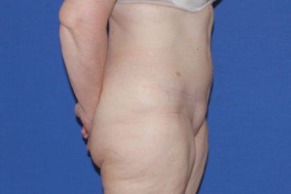 Tummy Tuck Before & After Patient #3352