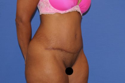 Tummy Tuck Before & After Patient #3260