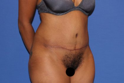 Tummy Tuck Before & After Patient #3287