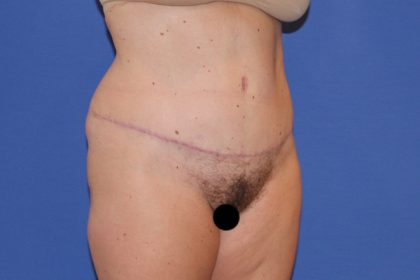 Tummy Tuck Before & After Patient #3268