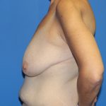 Breast Lift Before & After Patient #3459