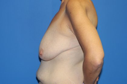 Breast Lift Before & After Patient #3459