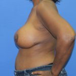Breast Augmentation with Lift Before & After Patient #2777