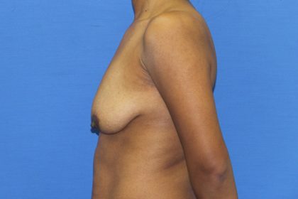 Breast Augmentation with Lift Before & After Patient #3062