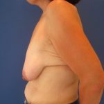 Breast Lift Before & After Patient #3415