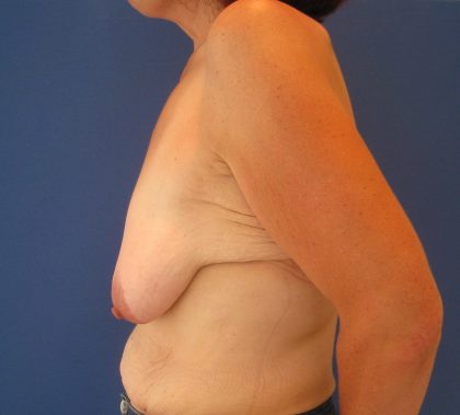 Breast Lift Before & After Patient #3415