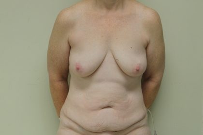 Breast Augmentation with Lift Before & After Patient #3041