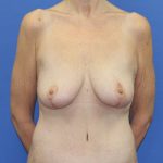 Breast Lift Before & After Patient #3459