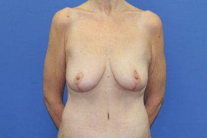 Breast Lift Before & After Patient #3459