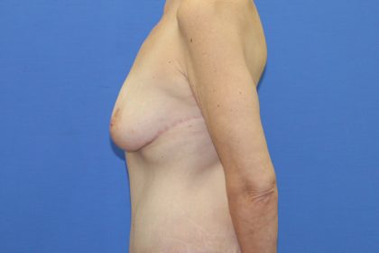 Breast Lift Before & After Patient #3459