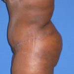Tummy Tuck Before & After Patient #3387