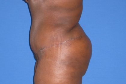 Tummy Tuck Before & After Patient #3387