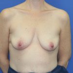 Breast Augmentation with Lift Before & After Patient #3055